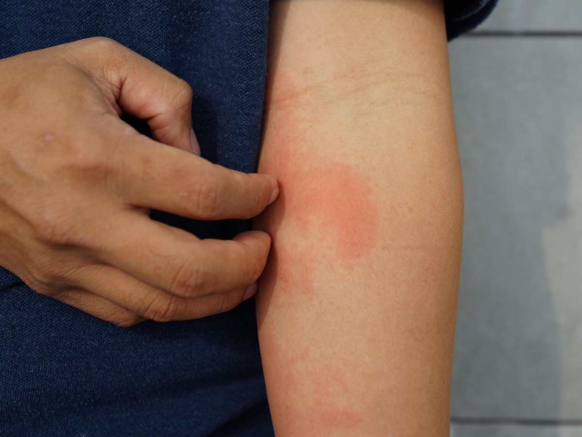 Allergie coude Amaël MALLEMONT Pôle Santé les Pléiades huiles essentielles