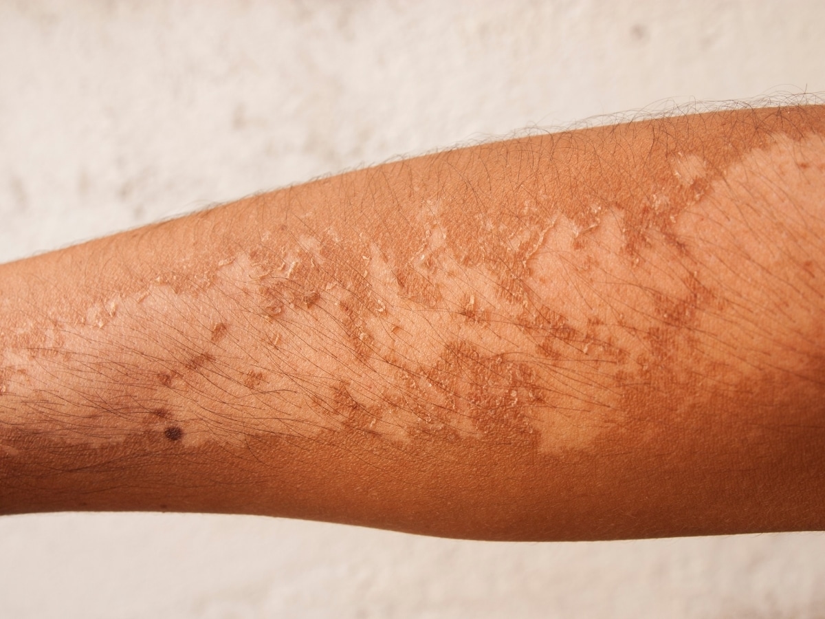 Coup de soleil Amaël MALLEMONT Pôle Santé les Pléiades huiles essentielles