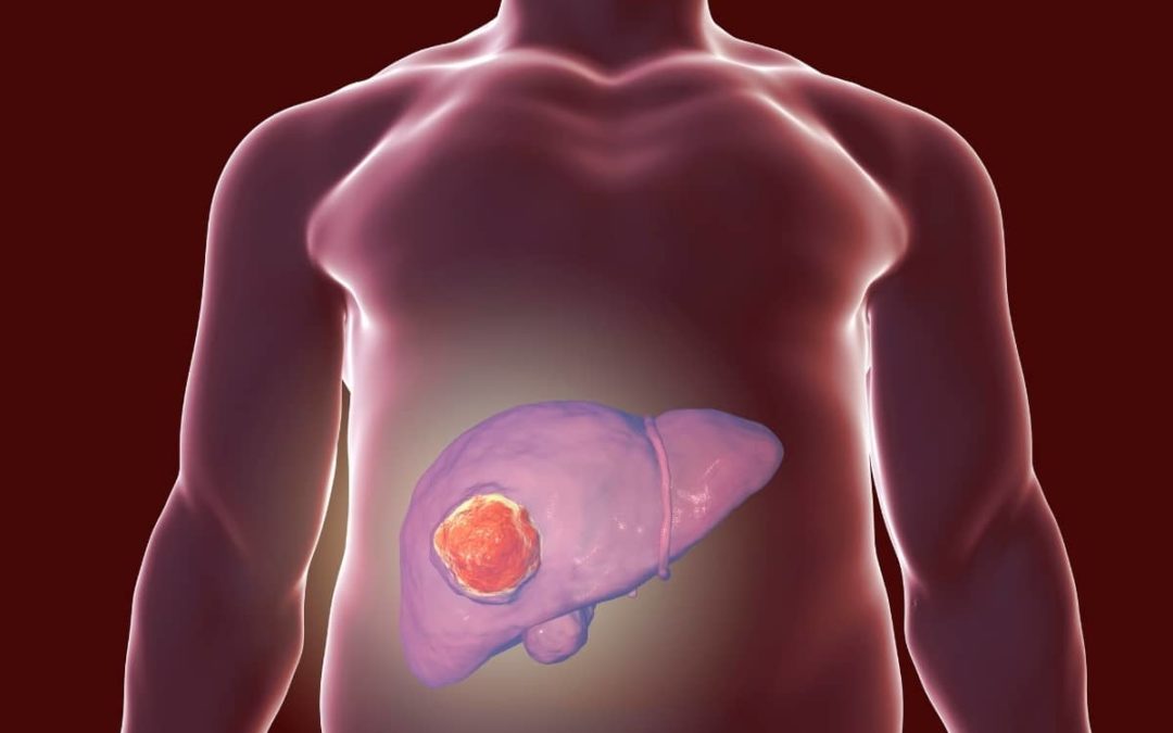 NASH / NAFLD / Maladie du foie gras