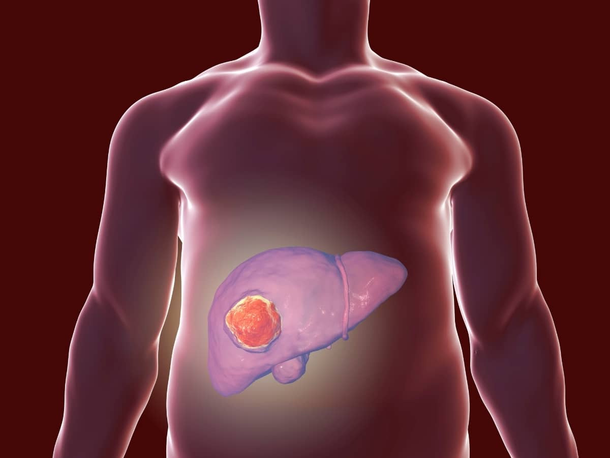 NASH NAFLD Amaël MALLEMONT Pôle Santé les Pléiades